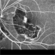 Macular Serpiginous Choroidopathy Macular Serpiginous Choroidopathy
